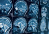 Когда и зачем назначают МРТ головного мозга?