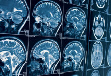 Когда и зачем назначают МРТ головного мозга?