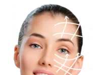 Что дает СМАС лифтинг