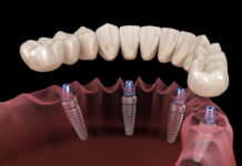 Виды и этапы имплантации зубов