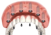 Что такое имплантация All-on-4 и All-on-6