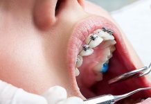 Этапы лечения брекетами