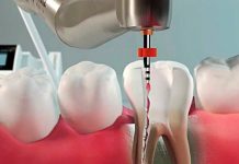 Лечение пульпита: основные методы и рекомендации