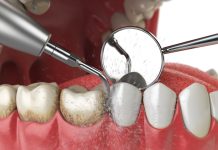 Болезненна ли процедура ультразвуковой чистки зубов?