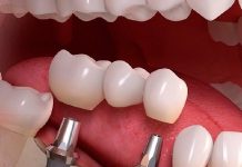 Имплантация зубов: восстановление улыбки и здоровья