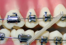 Резинки для брекетов: маленькие детали с большим влиянием на улыбку
