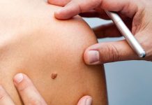 Удаление новообразований кожи