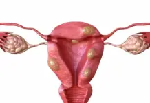 Современные методы лечения миомы матки