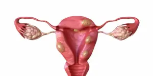 Современные методы лечения миомы матки