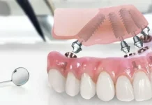 Особенности имплантации All-on-4