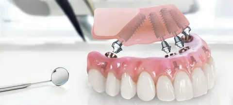 Особенности имплантации All-on-4