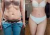 Вернуть себе привычное тело: когда пластика имеет смысл